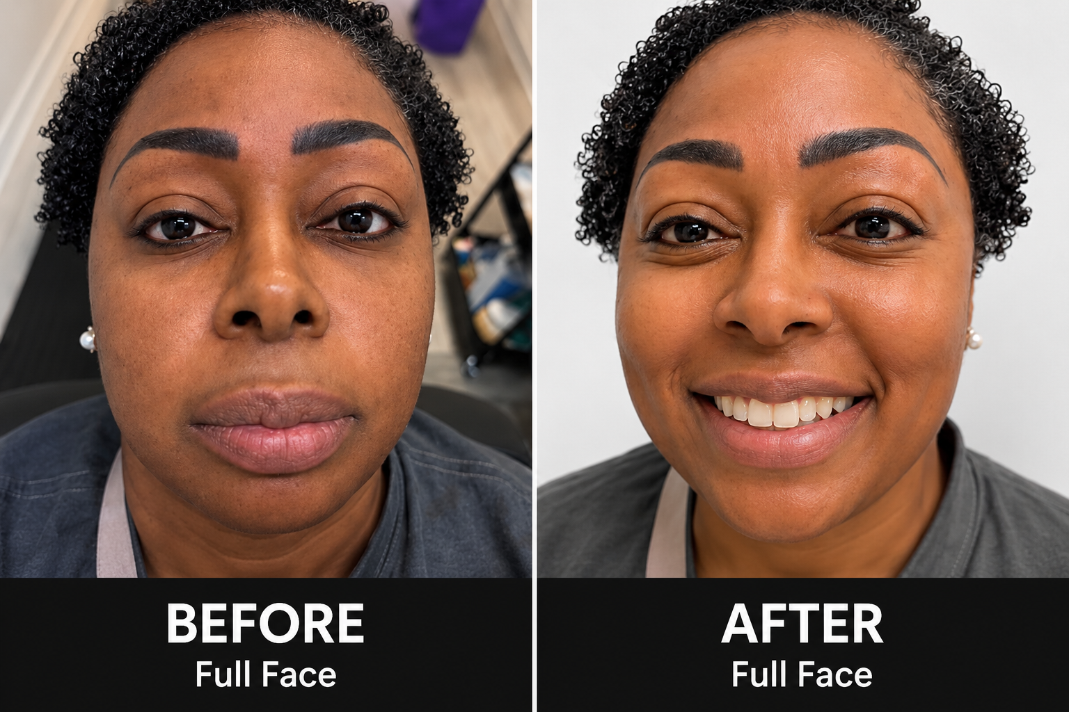 Real client full-face waxing result